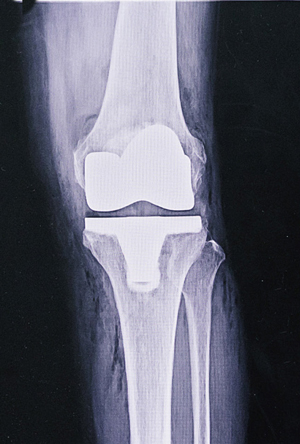 人工膝関節全置換術後のレントゲン