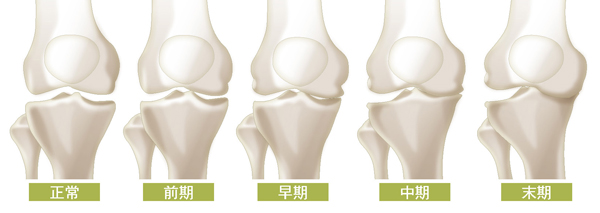変形性膝関節症の進行度