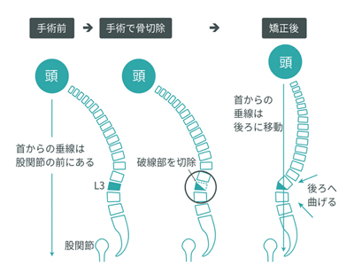 脊椎骨切り術