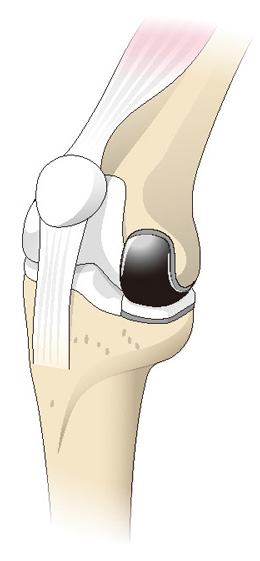 単顆型（片側型）人工膝関節置換術
