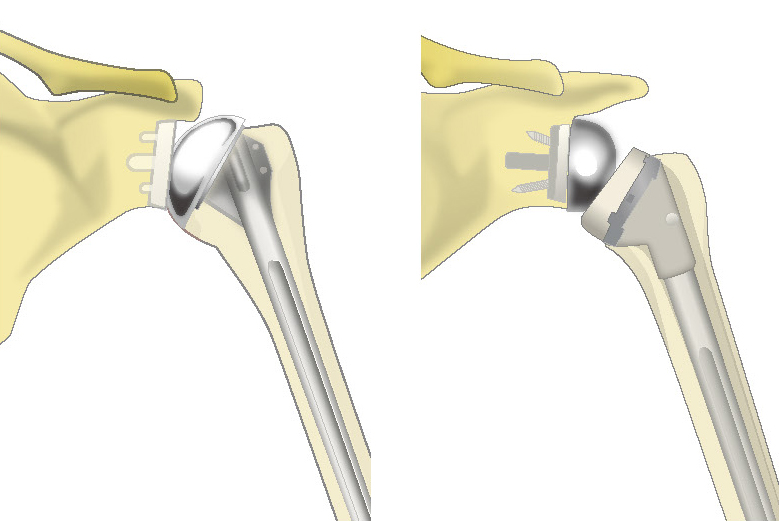 従来型の人工肩関節とリバース型人工肩関節