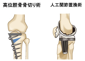 高位脛骨骨切り術／人工関節置換術