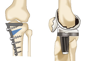 骨切り術と人工膝関節置換術