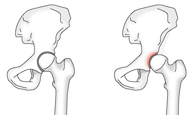 正常な股関節と臼蓋形成不全