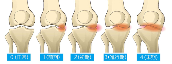 田渕 幸祐 先生 | 変形性膝関節症の治療法 | まずは膝の状態を知ること 