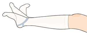 弾性ストッキングをはき、患者さんご自身で足首を動かす