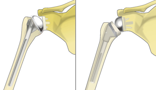 人工肩関節置換術（左）とリバース型人工肩関節置換術（右）