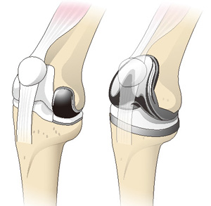 人工膝関節部分置換術と全置換術