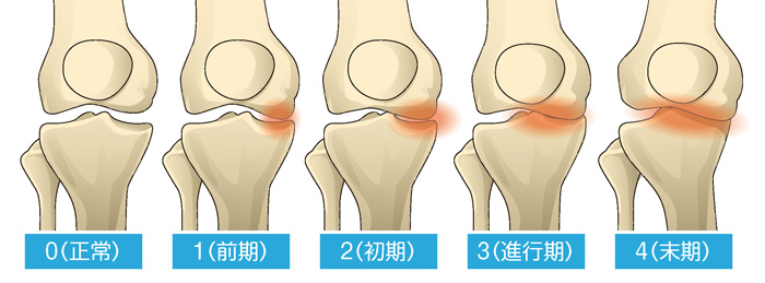 変形性膝関節症の5段階