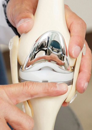 人工膝関節の一例