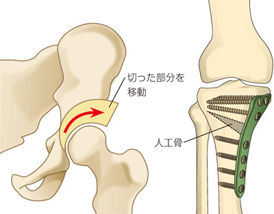 骨切り術（左・股関節、右・膝関節）