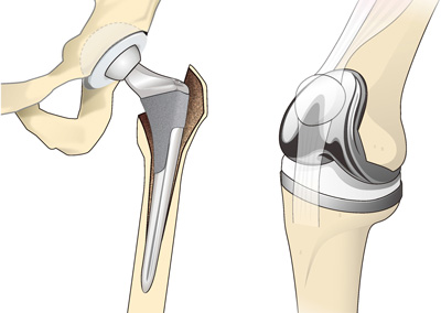 人工関節置換術（左・股関節、右・膝関節）