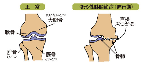 正常／変形性膝関節症（進行期）