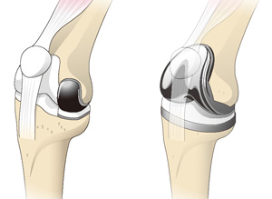 人工膝関節単顆置換術（左）と人工膝関節全置換術（右）