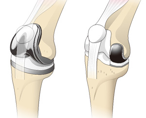 人工膝関節全置換術と単顆置換術