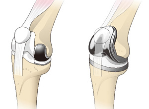 人工膝関節単顆置換術（左）と人工膝関節全置換術（右）