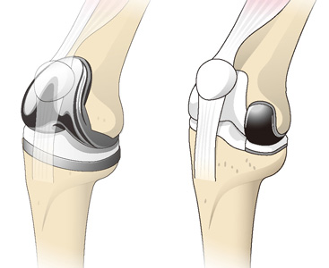 人工膝関節全置換術（左）と部分置換術（右）