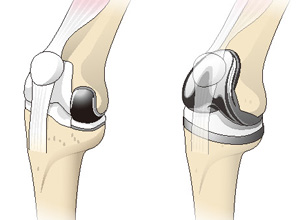 人工膝関節単顆置換術（左）と全置換術（右）