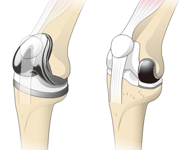 人工膝関節全置換術と部分置換術