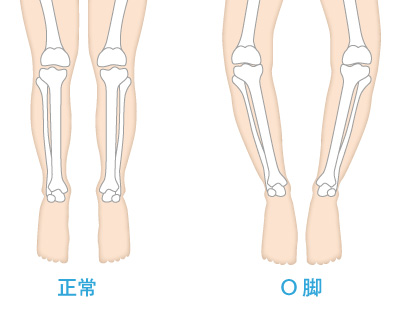 正常な膝とO脚
