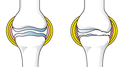 正常な膝（左）と炎症の起きた膝（右）