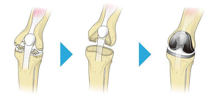 人工膝関節全置換術の流れ