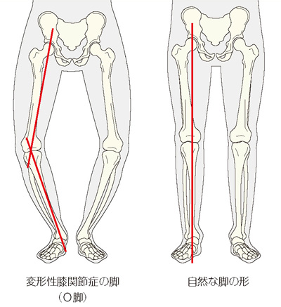 変形性膝関節症と自然な脚の形