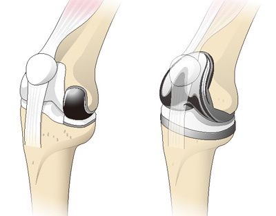 人工膝関節単顆置換術（左）と全置換術（右）