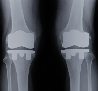 人工膝関節置換後（両脚）のレントゲン