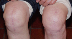 小野原さんの手術後のひざ。傷跡はほとんど目立たない（座位で撮影