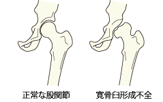 正常な股関節　寛骨臼形成不全